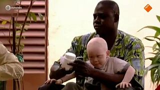 Albino's vogelvrij in Tanzania