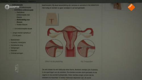 Problemen met sterilisatiemethode Essure